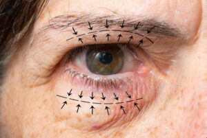Blefaroplastia Curitiba