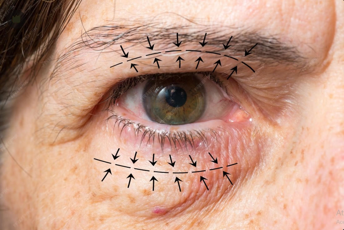 Blefaroplastia Curitiba